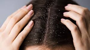 DANDRUFF